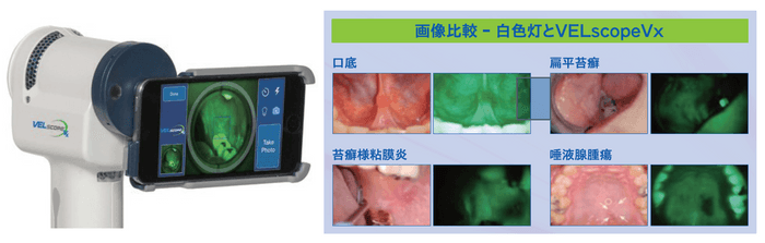 画像比較 白色灯とVELscopeVX 口底／扁平苔癬(へんぺいたいせん)／苔癬様粘膜炎／唾液腺腫瘍